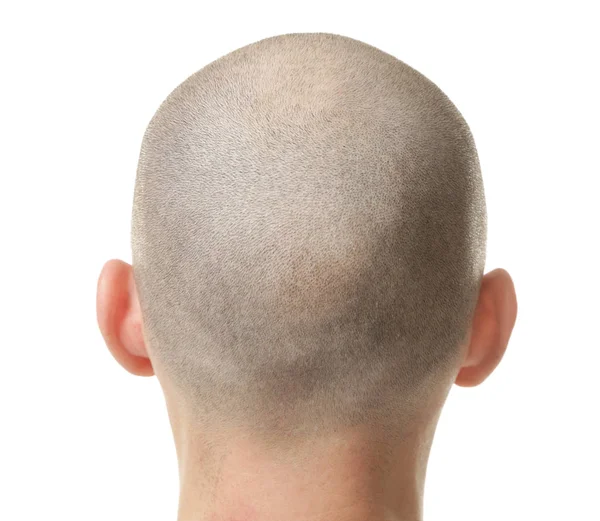 Como os pacientes descrevem a aparência dos cabelos após o implante capilar em BH?