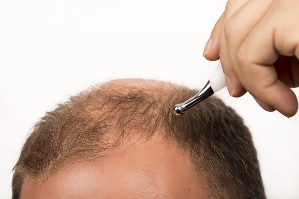 Quais são os benefícios do implante capilar em BH para preencher áreas com falhas no cabelo?